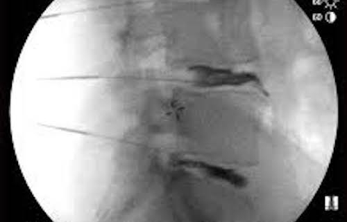 Intradiscal Fibrin Sea