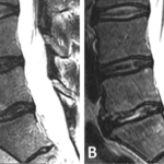 Increased Nuclear T2 Signal Intensity Post-Intradiscal Platelet–Rich Plasma Injection