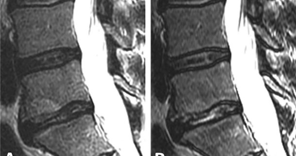 Increased Nuclear T2 Signal Intensity Post-Intradiscal Platelet–Rich Plasma Injection