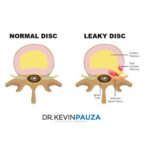 Treatment of Annular Disc Tears and "Leaky Disc Syndrome" with Fibrin Sealant