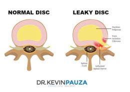 Treatment of Annular Disc Tears and "Leaky Disc Syndrome" with Fibrin Sealant