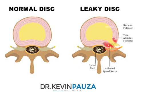 Treatment of Annular Disc Tears and "Leaky Disc Syndrome" with Fibrin Sealant