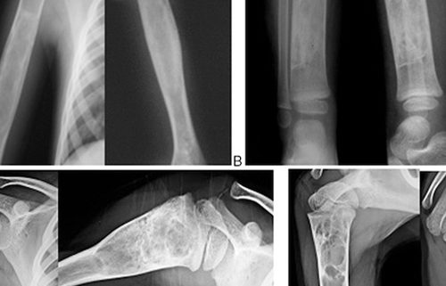 Lumbar Intradiscal Platelet-Rich Plasma