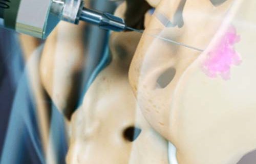 The Value of Medical History and Physical Examination in Diagnosing Sacroiliac Joint Pain.