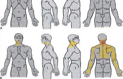Provocative Cervical Discography Symtom Mapping