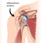 Treatment of Tendon and Muscle Using Platelet-Rich Plasma