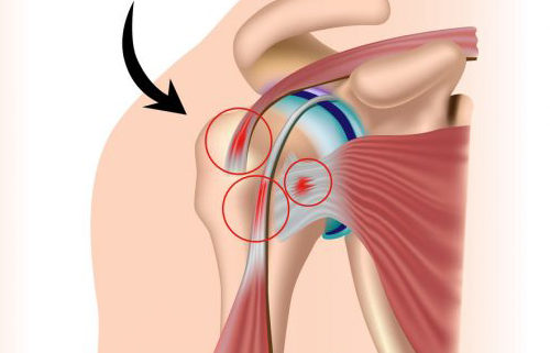 Treatment of Tendon and Muscle Using Platelet-Rich Plasma