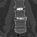 Lumbar Intradiscal Platelet-Rich Plasma