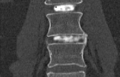 Lumbar Intradiscal Platelet-Rich Plasma