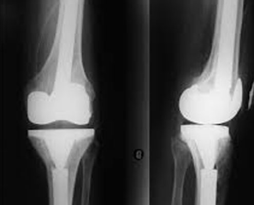 Subchondral stem cell therapy versus contralateral total knee