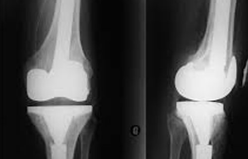Subchondral stem cell therapy versus contralateral total knee