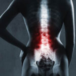 Intradiscal Platelet-Rich Plasma
