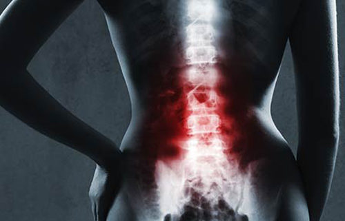 Intradiscal Platelet-Rich Plasma