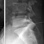 placebo-controlled trial of intradiscal electrothermal therapy