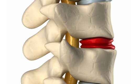 Regenerative Treatments for Spinal Conditions